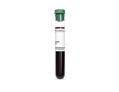 Solid Tumor Cancer, Hu PB, Fresh