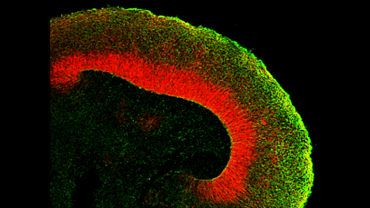 Brains in a Dish: Using Cerebral Organoids to Study Human Brain Development and Disease