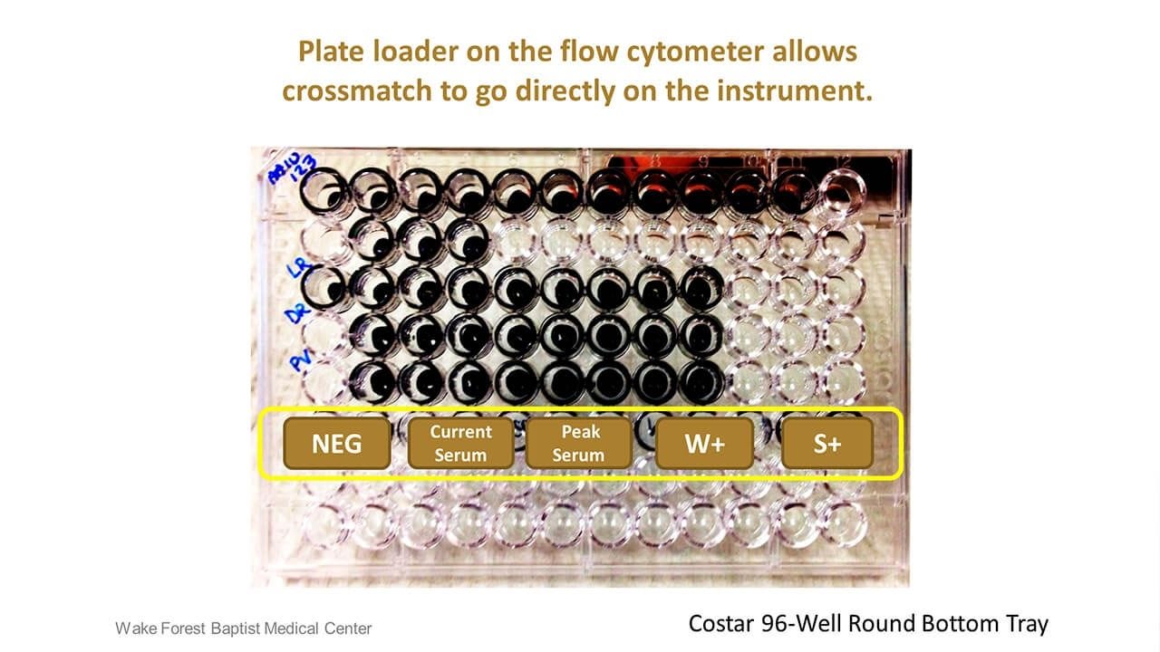 Considerations to Streamline the Flow Cytometry Crossmatch (FCXM) Assay