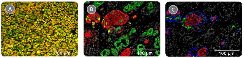 Pancreatic Differentiation of Progenitor Cells into Mature Endocrine and Exocrine Cells