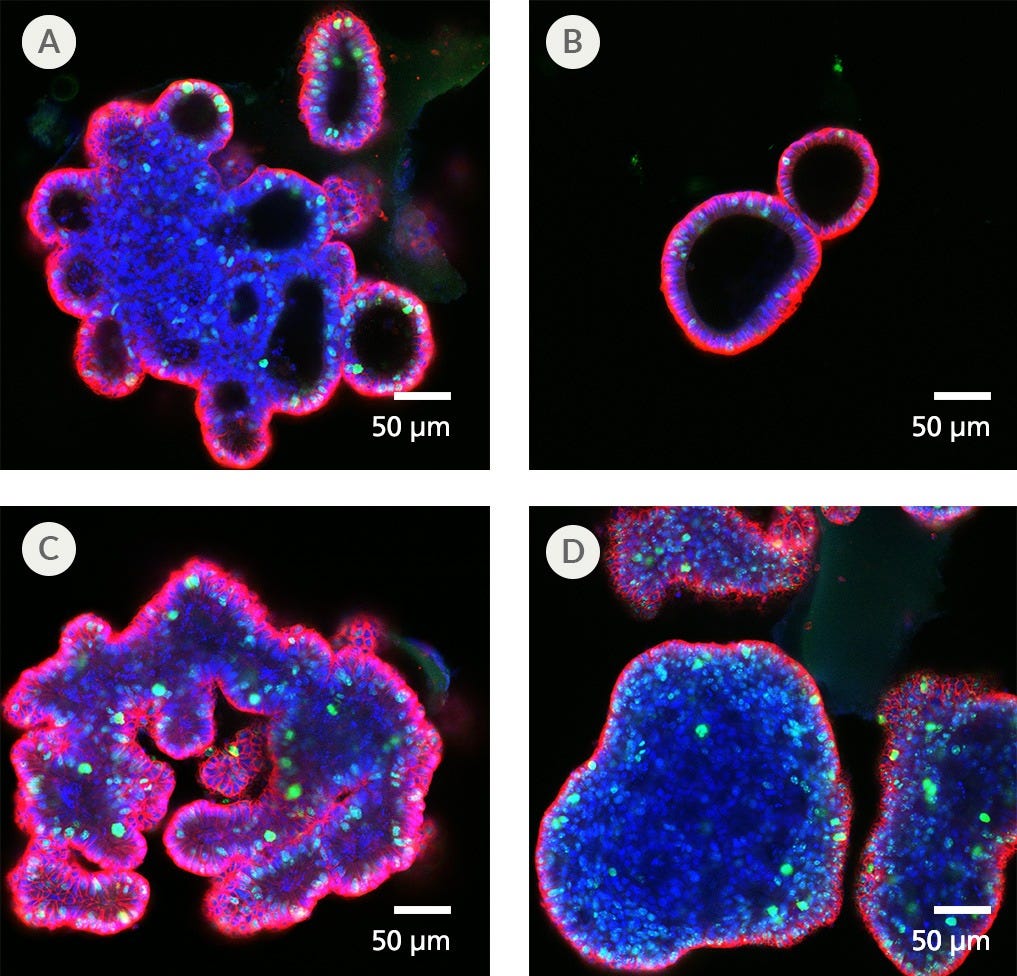 Confocal images of human colorectal cancer organoids stained with Ki67, EPCAM, and DAPI.