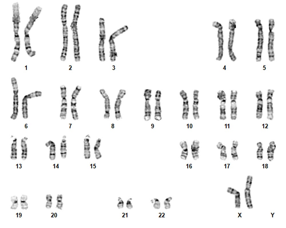 Typical human karyogram showing all chromosomes and no clonal abnormalities