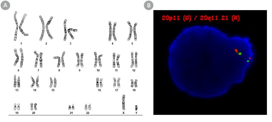 Figure 2. SCTi006-A Human Pluripotent Stem Cells Maintain a Normal Karyotype