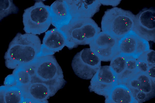 Learn to process bone marrow samples and isolate CD138+ plasma cells to increase FISH sensitivity for multiple myeloma testing.
