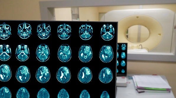 Image of glioblastoma brain scans.