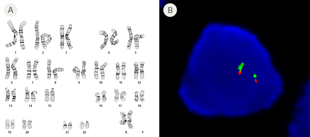 Chromosomes arranged in a normal karyotype and a cell image showing 2 fluorescent in situ hybridization probes